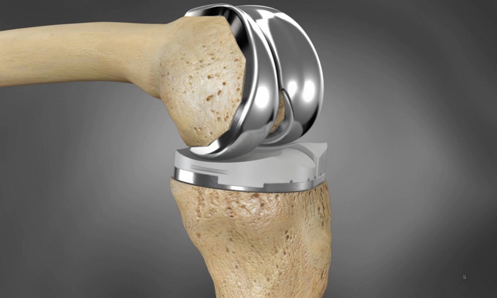 3D-gedrucktes Implantat für das Knie 3D Printed Implant for Knee